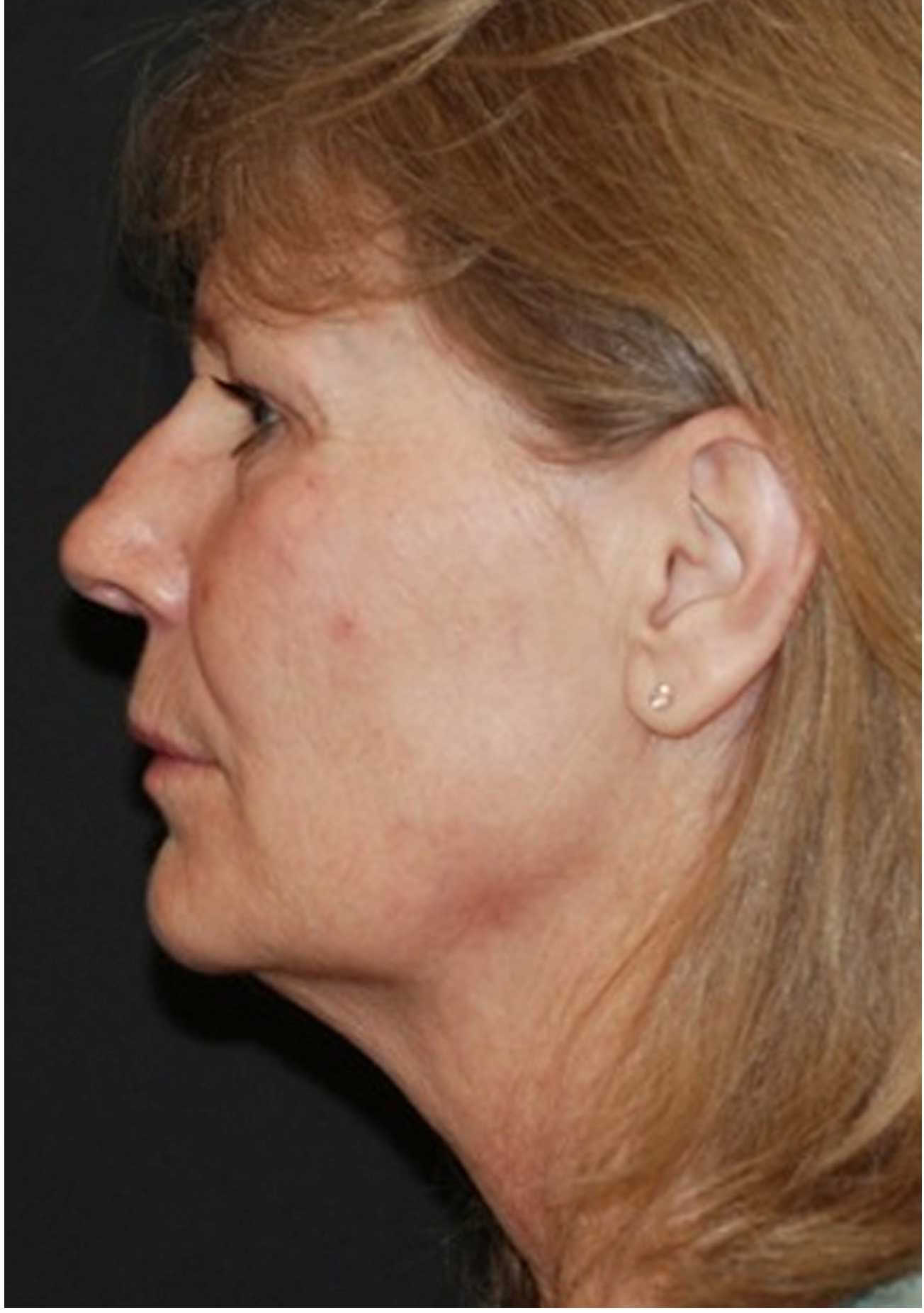 thermage after 
long island great neck